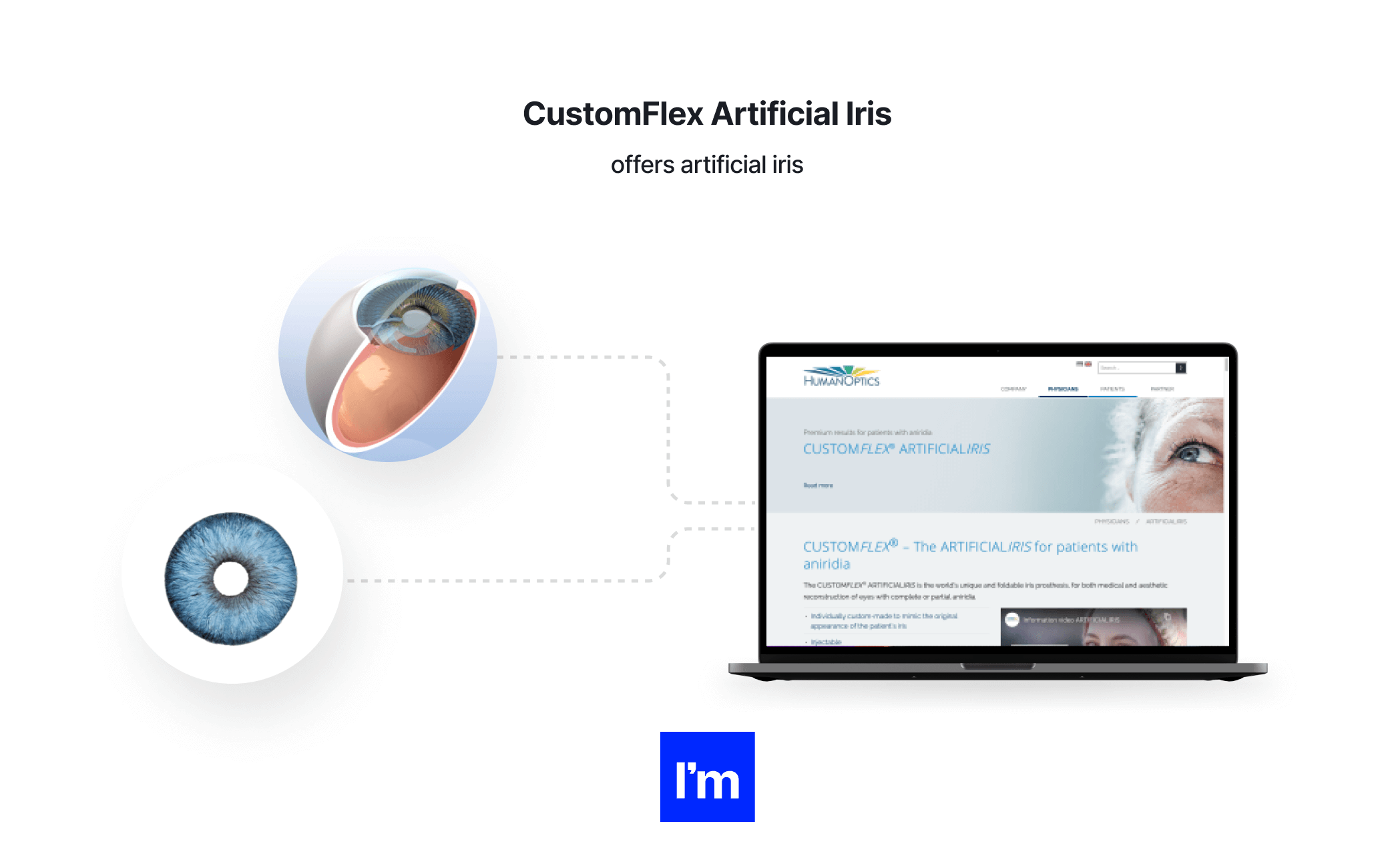 MedTech - CustomFlex Artificial Iris
