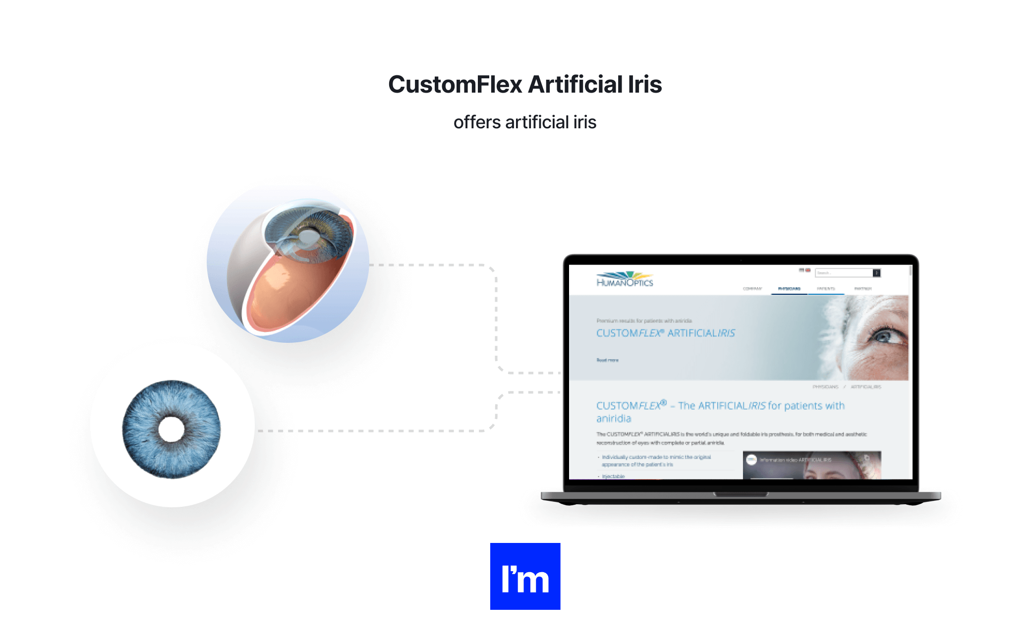 MedTech - sztuczna tęczówka CustomFlex
