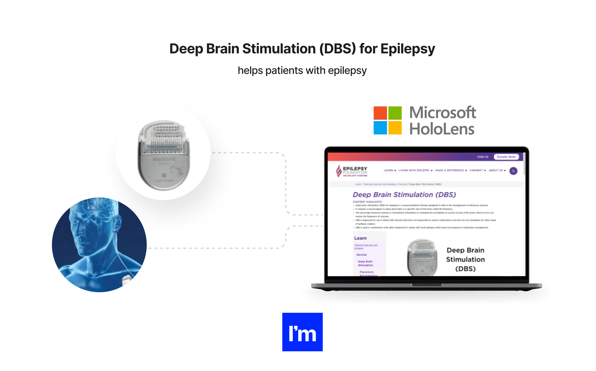 MedTech - Deep Brain Stimulation (DBS) for Epilepsy